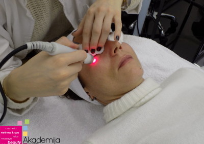 Kako radi tretman lica laserom