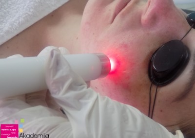 kako laserom tretmanom ukloniti akne