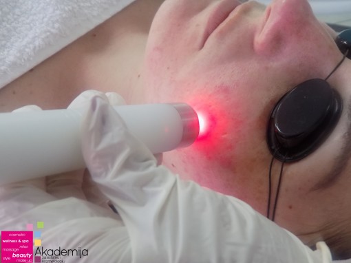Kako laser tretmanom ukloniti akne