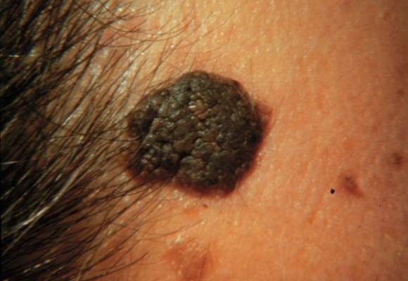 Tumori kože- benigni tumori