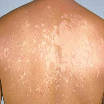 ŠTA JE PITYRIASIS VERSICOLOR? –  blaga, hronična infekcija kože
