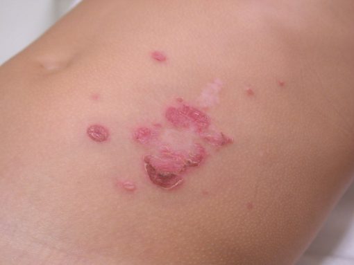 IMPETIGO STANJE KOŽE – površna bakterijska infekcija na koži
