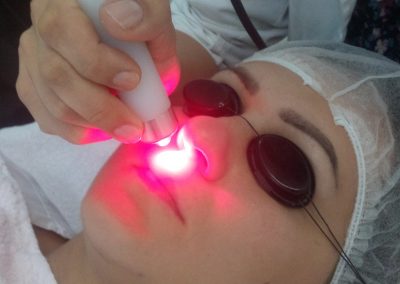 laseri u dermatologiji