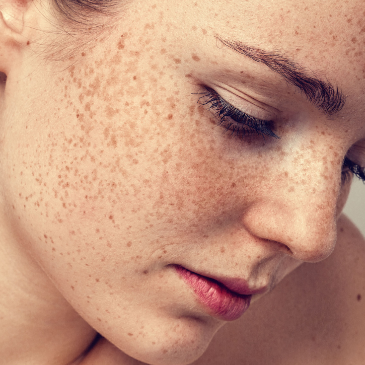 ŠTA SU HIPERPIGMENTACIJE NA KOŽI? – koji faktori utiču na promene na koži?
