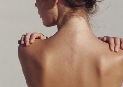 pojava akni na leđima