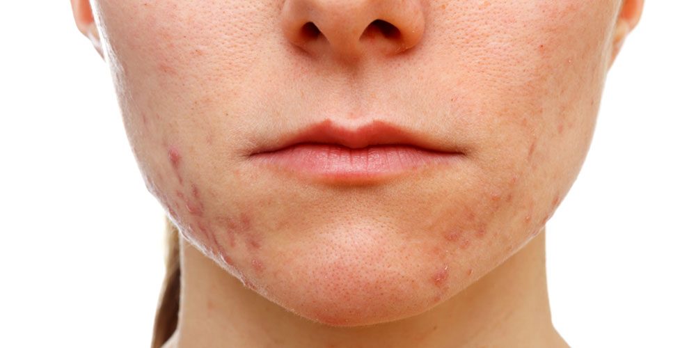 HORMONSKE AKNE – šta raditi nakon pregleda kod dermatologa?