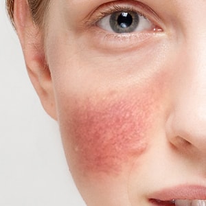 LEČENJE ROZACEE LASEROM – sprečite širenje crvenila i kapilara na licu